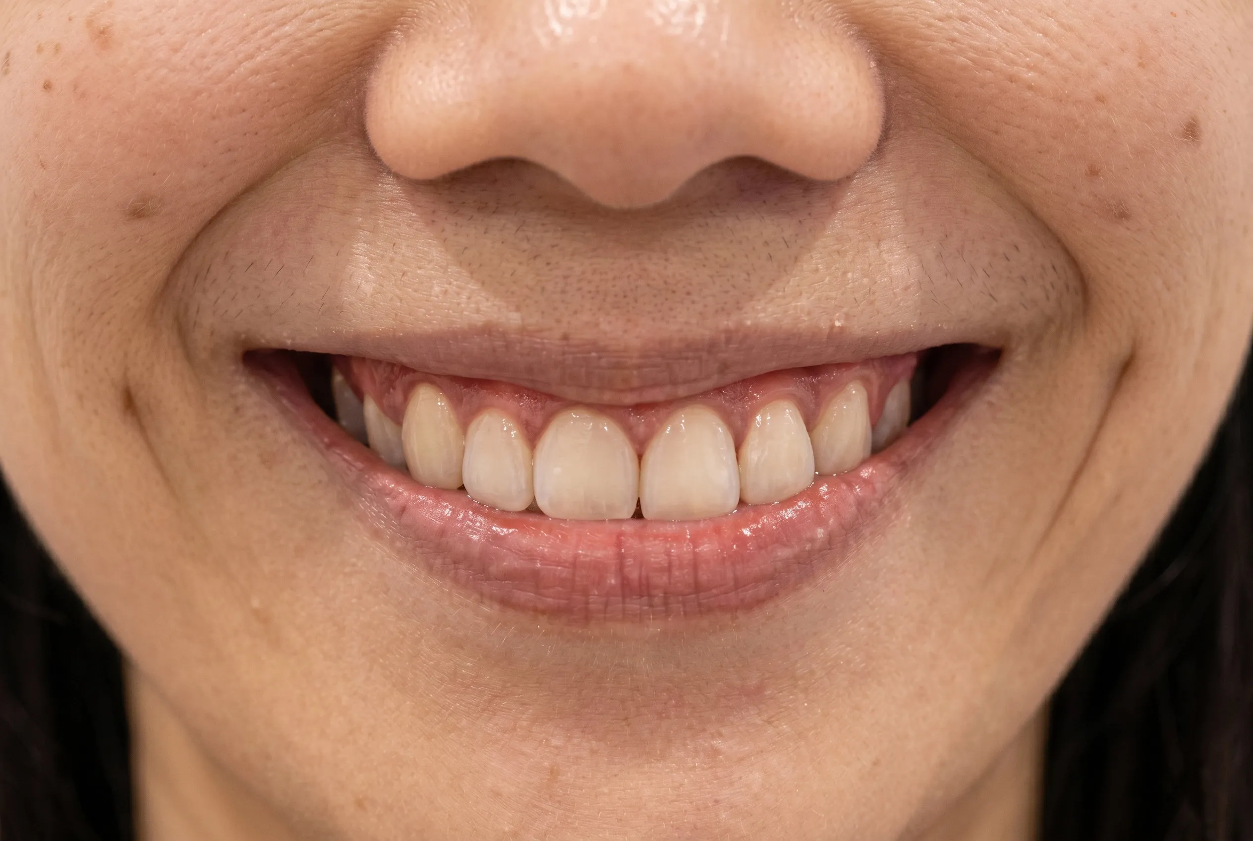 Gummy Smile Treatment - After